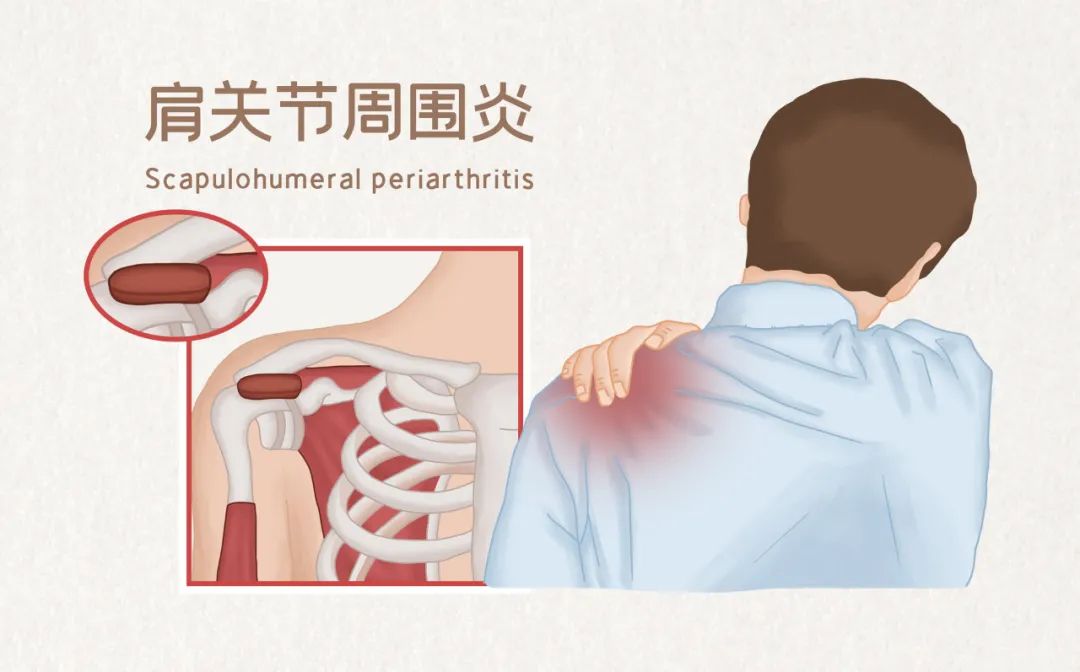 肩周炎在哪个位置图片