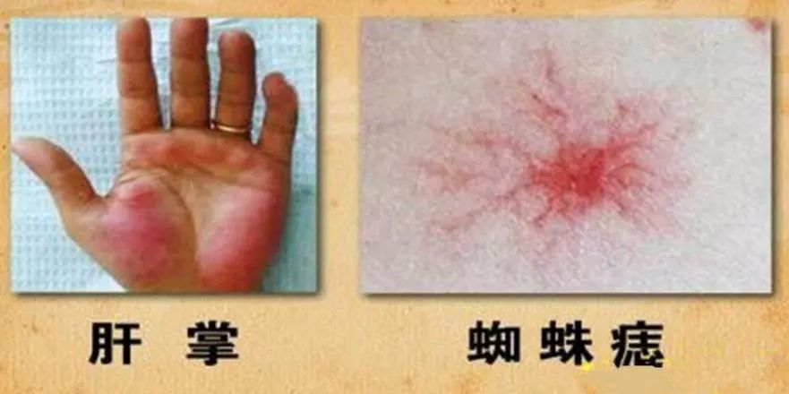 小鱼际和指尖掌面呈粉红色斑点和斑块)或蜘蛛痣(表现为面部,颈部及