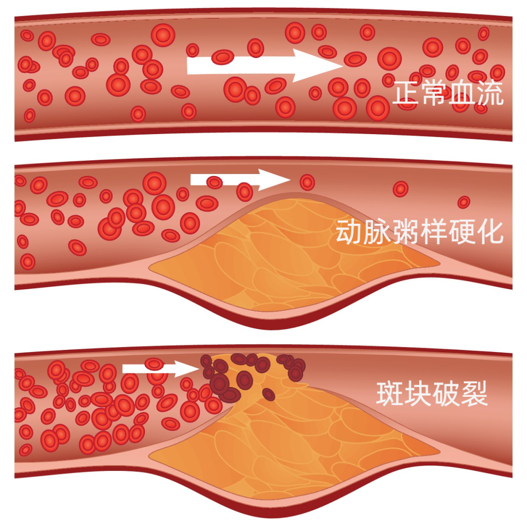 CT和MRI如何看正常及异常冠状动脉，高清图谱请收好！_冠状动脉_CT_MRI_医脉通