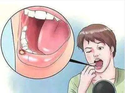 提醒 反复口腔溃疡 可能是身体发出疾病的征兆 提醒 反复口腔溃疡 可能是身体发出疾病的征兆