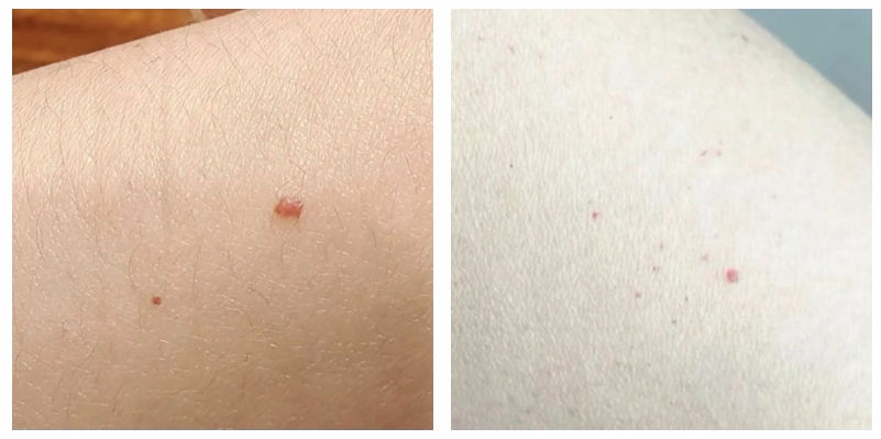 会癌变吗?医生提醒