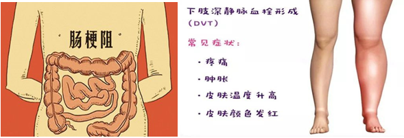 实用 术后如何尽快让自己放屁 妙招来了